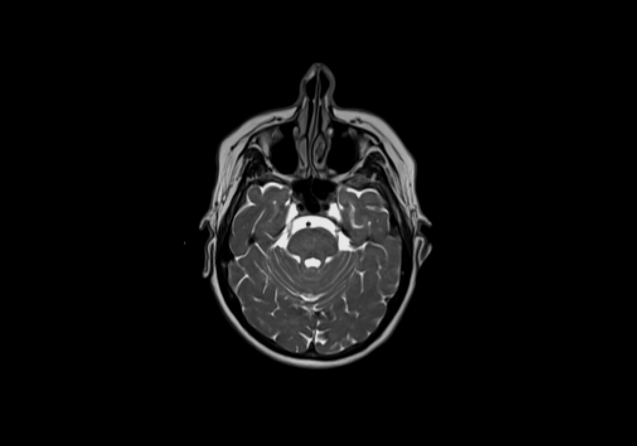 Neck axial  lymph node cross sectional MRI anatomy 3T MRI  image-img-00001-00011.webp